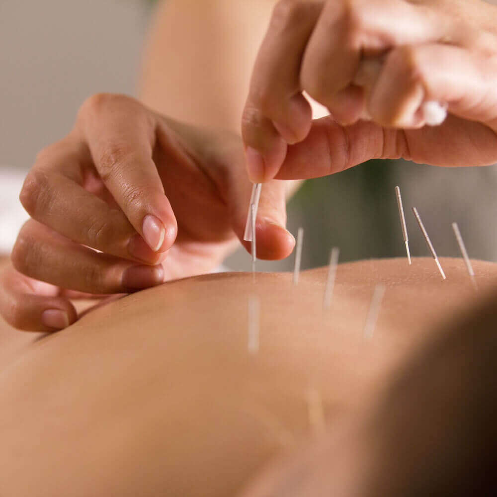 The doctor sticks needles into the woman's body on the acupuncture